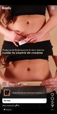 Captura real de un reel con anuncio de queloide.cl sobre la lámina de silicona para la cicatriz de cesárea.